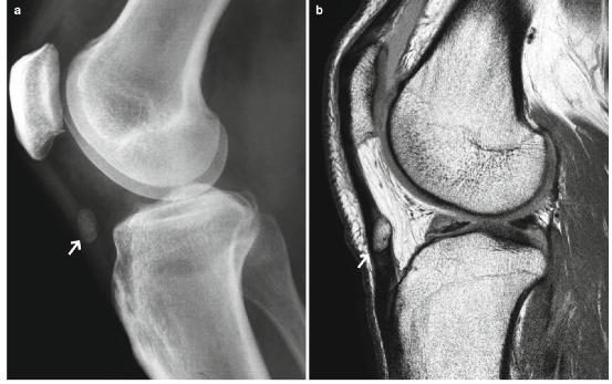髕腱炎成為醫(yī)學(xué)焦點(diǎn)，從幕后走向舞臺中央的最新進(jìn)展