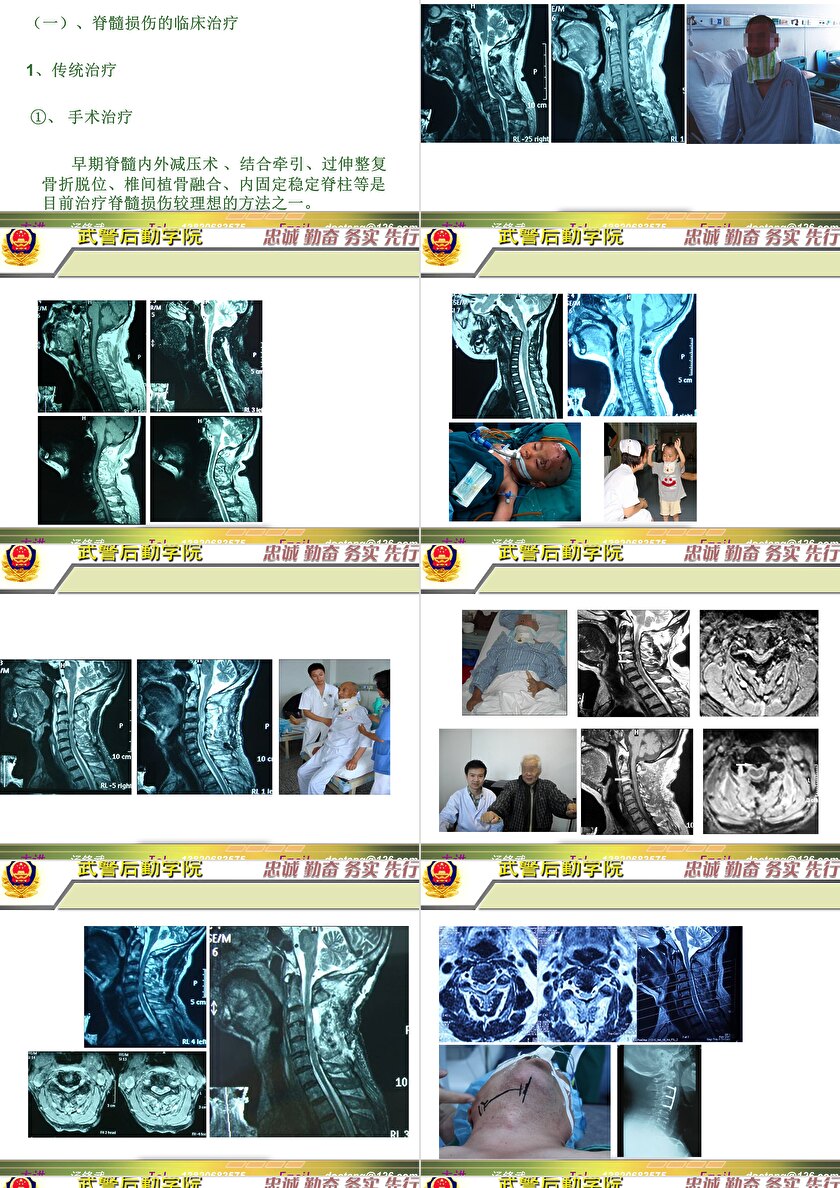 2023年脊髓損傷研究新進(jìn)展，里程碑式的突破與日常奇妙變化