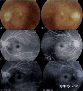 最新藥肺炎詳解，你需要知道的一切——健康小紅書